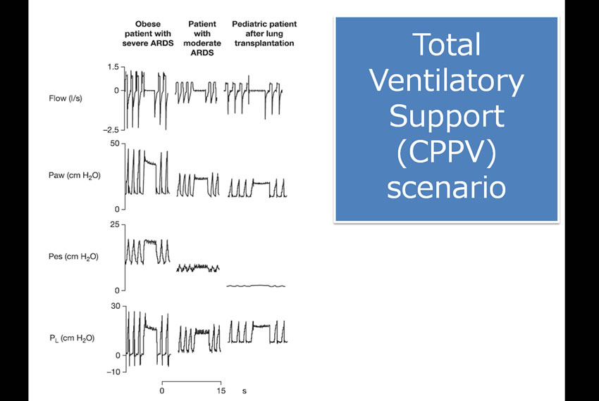 Total ventilatory support scenario