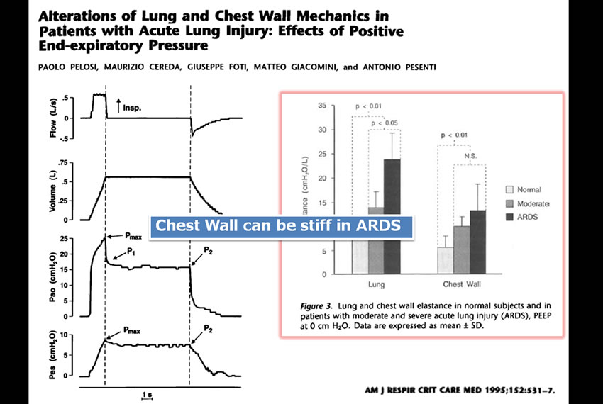 chest wall can be stiff in ards