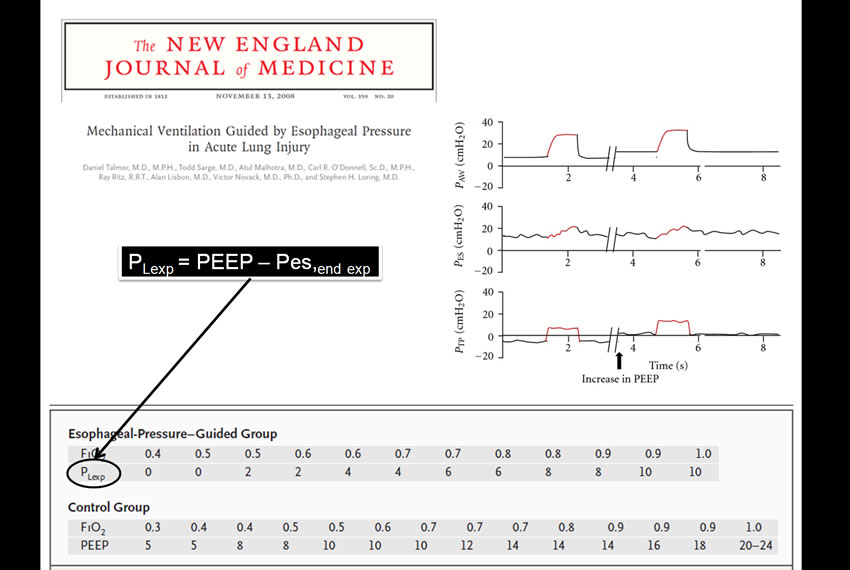 mechanical ventilation guided by esophageal in acute lung injury