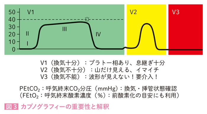 カプノグラフィーの重要性と解釈