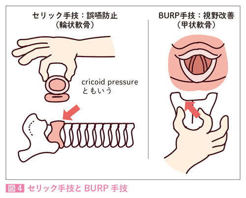 セリック手技とBURP手技